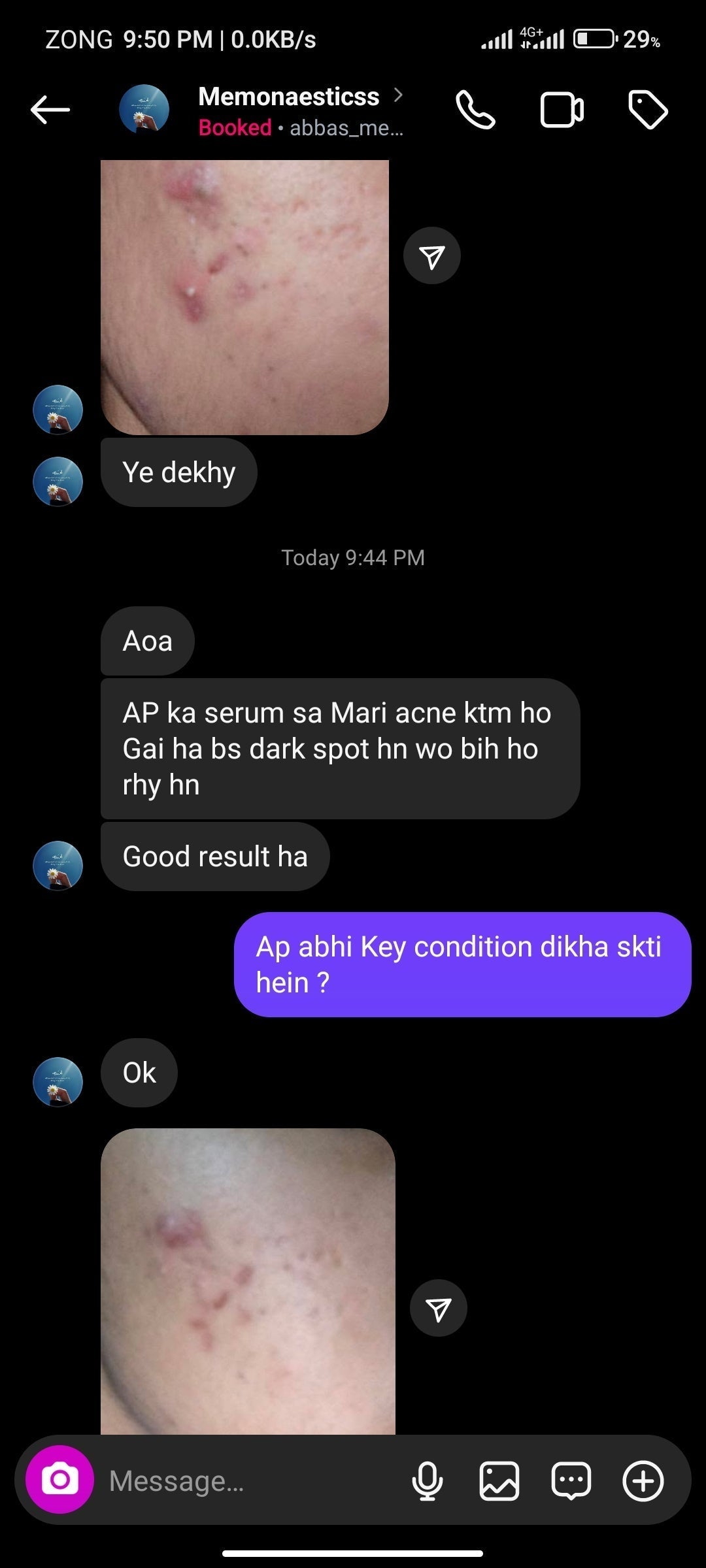 Anti Acne & Glowing Serum | Salicylic 2%, Vitamin C & E and Tea Tree Extract 2%